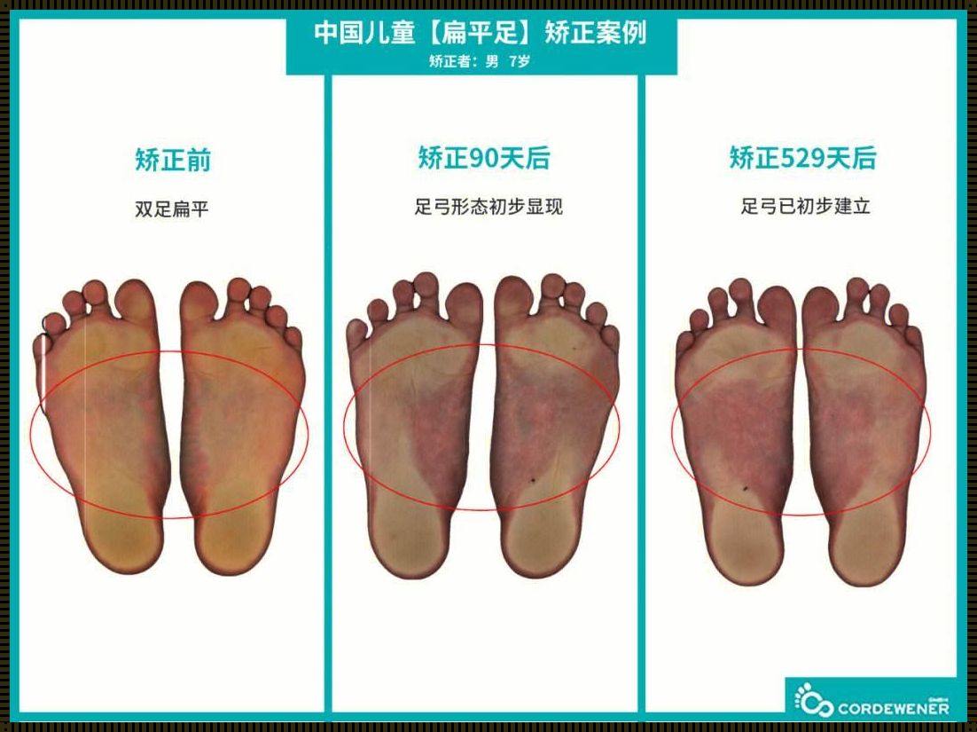 小孩扁平足的矫正之路：寻找最佳方法