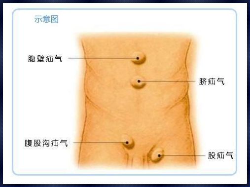 男左下腹疝气痛的症状解析